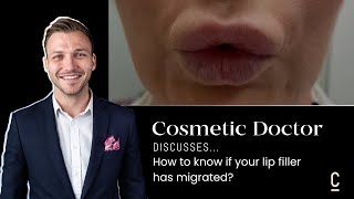 HOW TO KNOW IF YOUR LIP FILLER HAS MIGRATED [upl. by Bambie168]