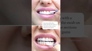 Enlighten  Teeth Whitening Process  London  Whites Dental [upl. by Kling]