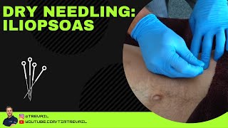 Dry Needling Iliopsoas [upl. by Whiffen619]