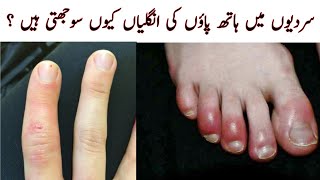 why fingers swell in winter  Treatment at home  Tips and Tricks by Maryam [upl. by Tnelc]