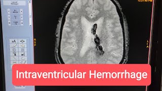 How to Diagnose Intraventricular Hemorrhage on MRI of Brain [upl. by Grae118]