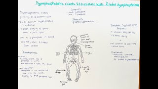 Hypophosphatemic Rickets Xlinked Hypophosphatemia Vitamin D resistant Rickets [upl. by Tebazile]