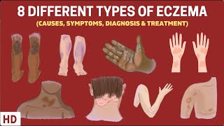 Eczema Exposed 8 Types You Need to Know [upl. by Eagle]