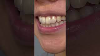 4 Veneers for this dentist patient readdescription veneers dental [upl. by Aneerak]