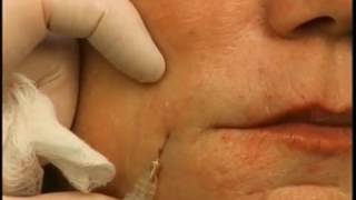 How to Lift Mouth Corners amp Marionettes With A Dermal Filler [upl. by Suiramad]