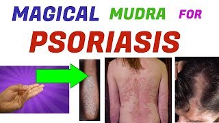 Mudra For PsoriasisYoga Mudra For PsoriasisScalp Psoriasis Treatment At Home In Hindi [upl. by Jauch524]