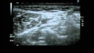 Posterior Tibial Nerve Block Ultrasound guided [upl. by Maxentia]