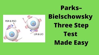 Parks Bielschowsky Three Step Test Made Easy [upl. by Enaile72]