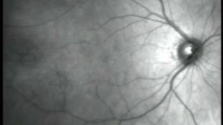 Eye Floaters Video 2 [upl. by Zacherie]