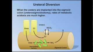 Normal Anion Gap Metabolic Acidosis ABG Interpretation  Lesson 9 [upl. by Notwal297]