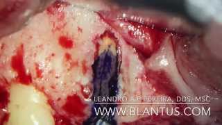 Endodontic Microsurgery [upl. by Amalea440]