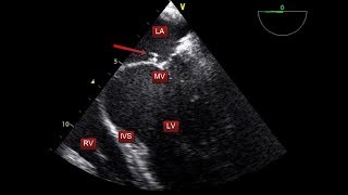 A simple transesophageal echocardiography quiz and introduction to TEE views TOE [upl. by Nagem]