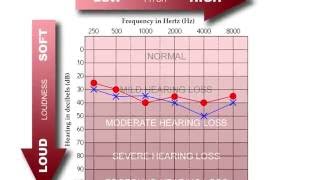 How to Read an Audiogram [upl. by Chemash575]