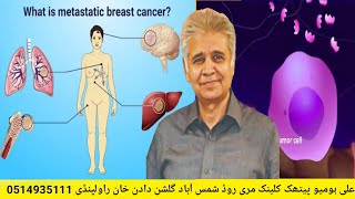 Metastasis Cancer and its Homoeopathic Treatment [upl. by Keriann]