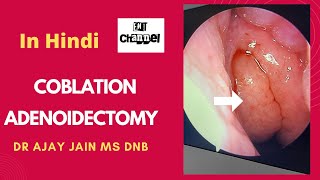 Coblation Adenoidectomy in hindi [upl. by Nyleak799]