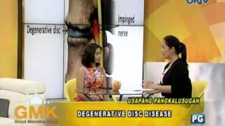 Degenerative Disc Disease [upl. by Lucy]