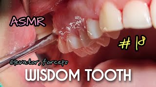 ASMR Wisdom Tooth Extraction in 35 Seconds [upl. by Seroka958]