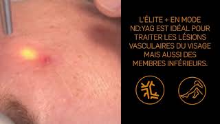 Tutoriel n°6  Traitement dun angiome stellaire avec le laser Elite par le Dr Patarin [upl. by Anivel]