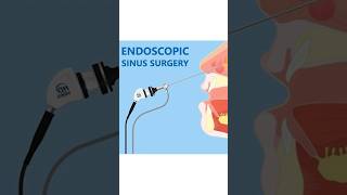 Balloon Sinuplasty vs Endoscopic Sinus Surgery [upl. by Brinkema]