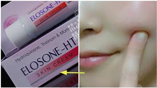 ELOSONEHT SKIN CREAM  SIDE EFFECTS  Pigmentation Killer [upl. by Lorelei]