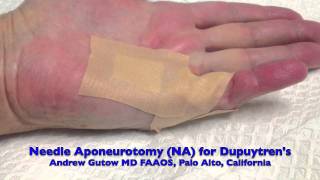 Office Treatment of Dupuytrens Contracture Needle Aponeurotomy and Xiaflex Injection [upl. by Esbensen]