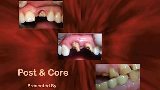 Post amp Core Upgrade Dentistry Webinar Dr Harpreet Singh  Part 1 [upl. by Shepherd]