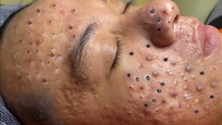 Big Cystic Acne Blackheads Extraction Blackheads amp Milia Whiteheads Removal Pimple Popping  8622 [upl. by Francesca]