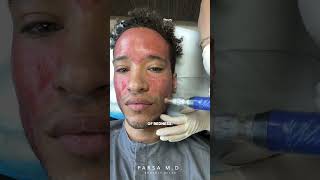 Microneedling with PRP for Acne Scars  Kami Parsa MD skincare acnescars [upl. by Esmeralda]