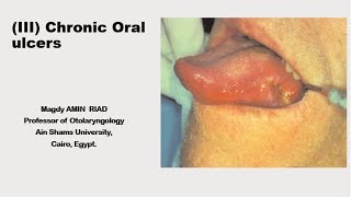 III Chronic Oral Ulcers [upl. by Magna]