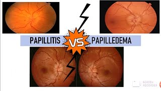 PAPILLITIS vs PAPILLEDEMA [upl. by Yelyak]