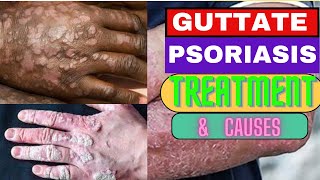 How to cure GUTTATE PSORIASIS CAUSES OF PSORIASIS TREATMENT PHOTOTHERAPY DERMATOLOGY AUTOIMMUNE [upl. by Nnywg418]