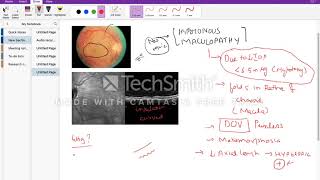 Hypotonous maculopathy [upl. by Field]