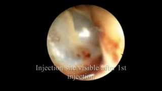 Sudden Hearing Loss Treatment SSHL  Intratympanic Steroid Injection [upl. by Lubbock]