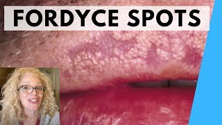 SYRINGOMA VS FORDYCE SPOTS  NATURAL REMEDIES [upl. by Nolaj726]