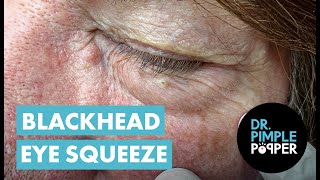 Blackhead Eye Squeeze [upl. by Ramalahs323]