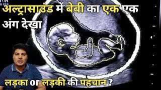 ultrasound se jane ladka ya ladki  sonography se kaise jane ladka hai ya ladki  level 2 ultrasound [upl. by February]