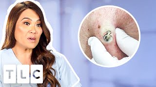 Top 5 Pimple Popping Moments From A 55YearOld Blackhead To Oozing Fistulas [upl. by Derby]