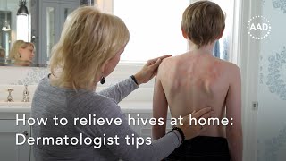 home remedies for rashes  how to get rid of rashes fast  home remedies for rashes on face [upl. by Allemat]