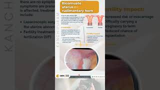 Bicornuate Uterus Laparoscopy  Dr Divya  Kanchipuram  EMMESS [upl. by Shanley150]