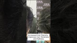 Best PRP treatment for Hair Loss Problems at Skinaa Clinic viral shorts trending [upl. by Kerge872]