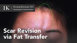 Treatment of Morphea en coup de sabre using Fat Transfer for forehead scar  Dr Hooman Khorasani [upl. by Bandeen461]