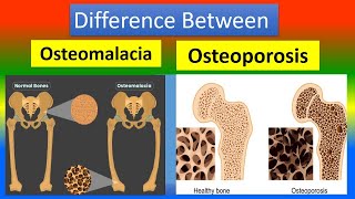 What is the difference between Osteoporosis and Osteoarthritis [upl. by Neik]