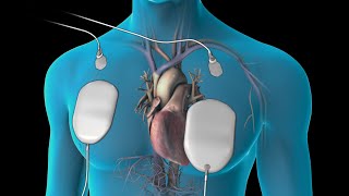 Cardioversion for Atrial Fibrillation [upl. by Madella]