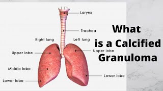 What is a Calcified Granuloma [upl. by Aramad]