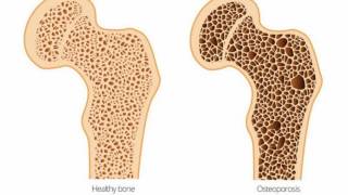 The TRUTH About Osteoporosis and Osteopenia [upl. by Panchito]