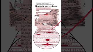 Myofascial pain syndrome [upl. by Ibur]