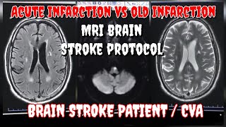 Acute Infarction vs Chronic Infarction Old Lacunar Infarction in MRI Brain  Stroke Patient MRI [upl. by Llemhar]