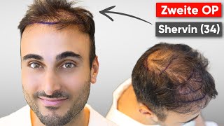 Shervins zweite Haartransplantation  Erfahrung VLOG [upl. by Norene]