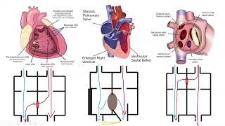 Infective Endocarditis in Pediatrics 8 [upl. by Given283]