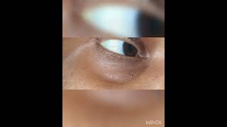 Part 1 3rd Nerve Oculomotor nerve palsy  Ptosis amp MydriasisDrKamaleshTNMediCalLectures [upl. by Auka123]